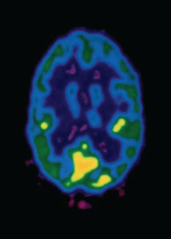 Normal brain MRI scan