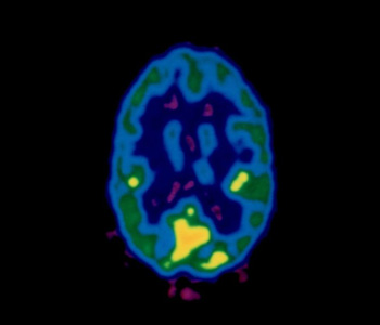 Normal brain MRI scan