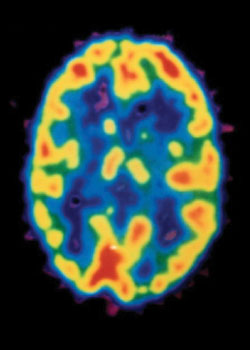 Brain MRI with SWORN supplementation