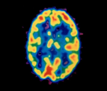 Brain MRI with SWORN supplementation