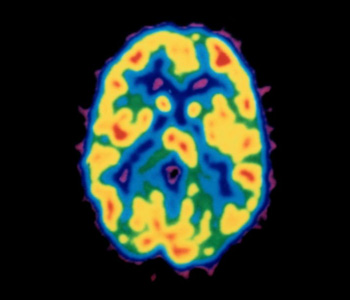 Brain MRI during urge state